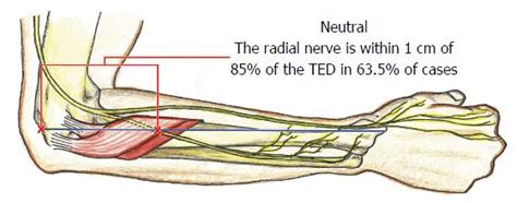 Posterior Interosseous Nerve