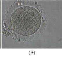 Human oocytes at different maturation stages. A: immature oocyte (GV ...