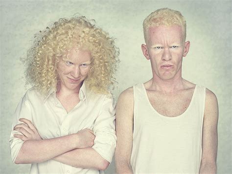 Albinism in humans Pictures – 26 Photos & Images / illnessee.com