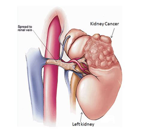 Doctors Save Life of 5-Year-Old Somali Girl – Conduct Complex Kidney ...