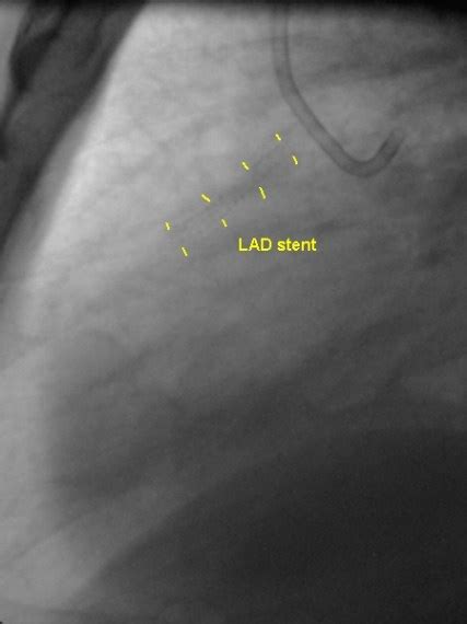 PTCA stenting of LAD total occlusion – Cardiophile MD