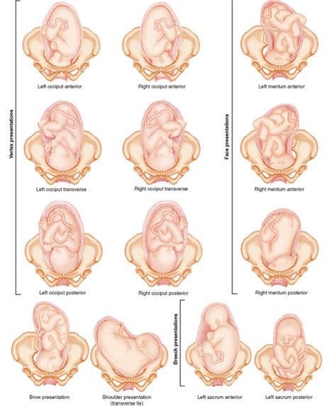 Home birth 10 signs it s time to transfer a home birth to the hospital – Artofit