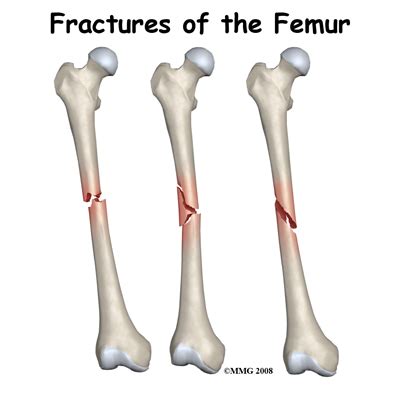 Femur Fracture Specialist | 🩺Singapore Sports & Orthopaedic Surgeon