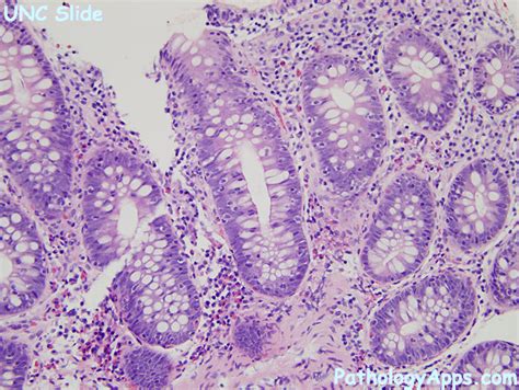 lymphocytic colitis pathology