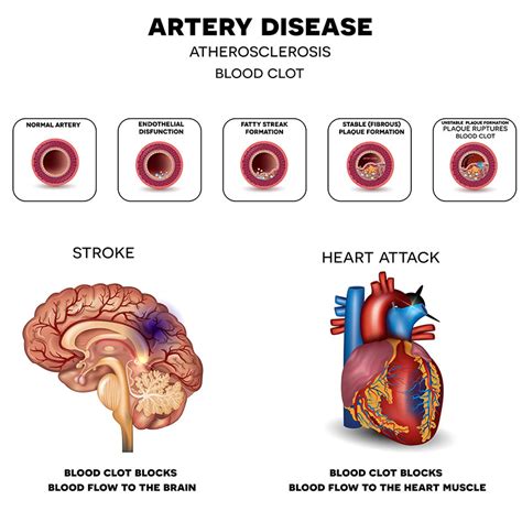 New York Carotid Artery Blockage, Stroke Prevention Procedures | NYC