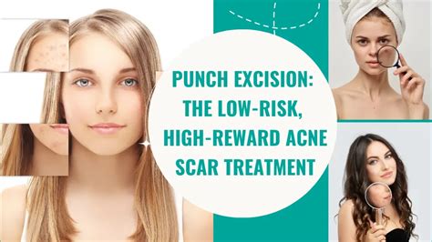 Punch Excision- A Quick, Effective Way to Remove Skin Lesions