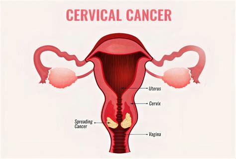 Colposcopy & Cervical Biopsy | Purpose,Preparation, Procedure, Results, complications and More ...