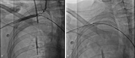 Angiographic images. Anteroposterior projection. (A) Subclavian artery ...