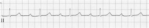 PR Interval • LITFL • ECG Library Basics