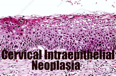 Cervical Intraepithelial Neoplasia (CIN) - Symptoms and Treatment