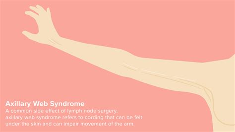 Axillary Web Syndrome (Cording)