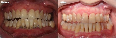 Dental Images Before and After in Indianapolis, IN | Sonrisa Dental