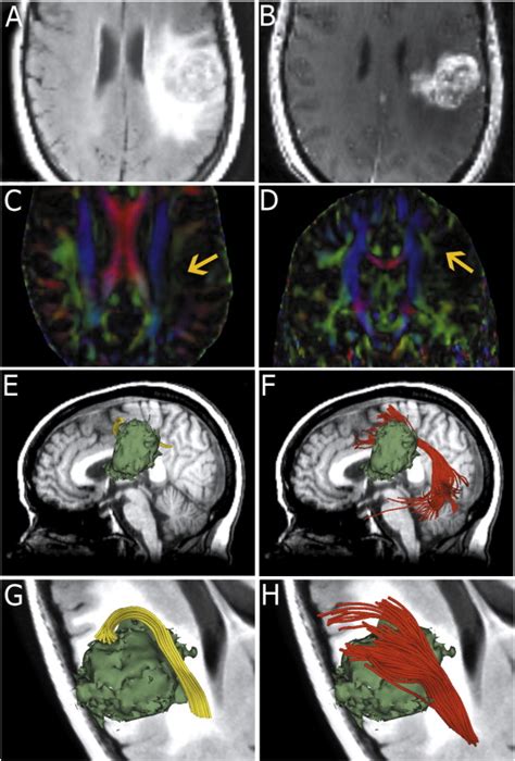 Images from patient 1 with a left fronto-parietal lesion.... | Download ...