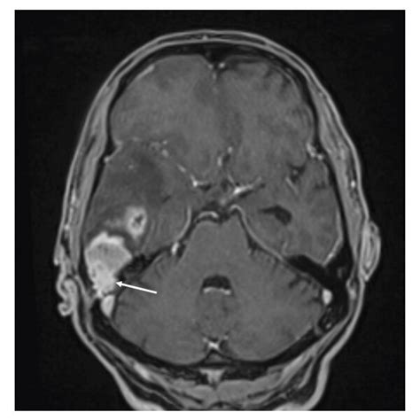 Axial plain CT (a) and contrast-enhanced MRI (b) at the level of the... | Download Scientific ...