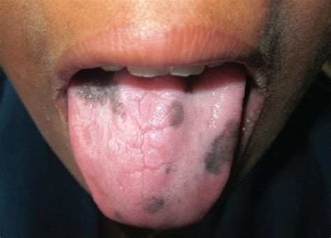 Hyperpigmentation seen on the dorsal surface of the ton | Open-i