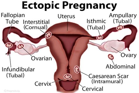 Ectopic Pregnancy: Symptoms and Treatments | Best OBGYN L...