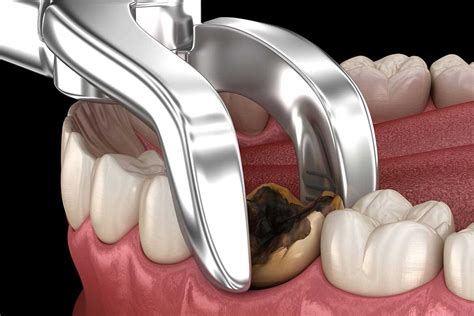 How much does a tooth extraction cost?