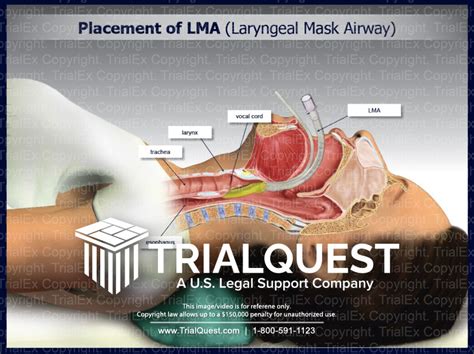 Placement of LMA (Laryngeal Mask Airway) - TrialExhibits Inc.