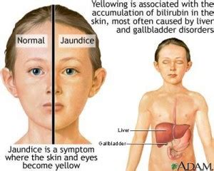 Jaundice Symptoms and causes | Medical Laboratories