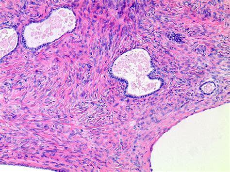 Serous Cystadenoma Histology