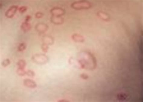 The Various Stages of Ringworm - Recognise Them And Deal With It Quickly | HubPages