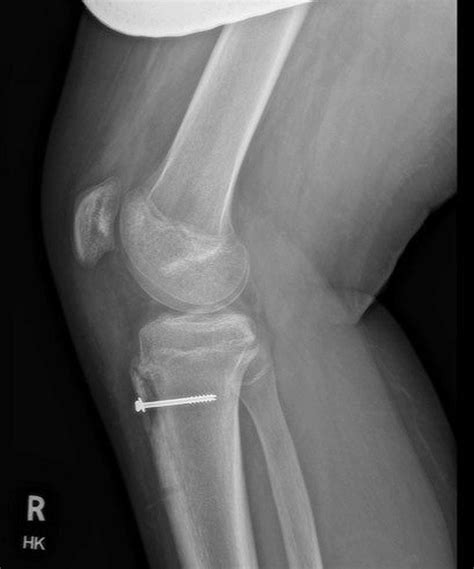 Osgood Schlatter Disease Avulsion Lesion Of The Tibial Tuberosity The ...