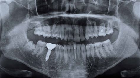 The ABCs of Dental Implants - Prairie Lakes Dental