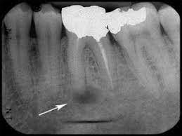 Abscessed Wisdom Tooth Xray