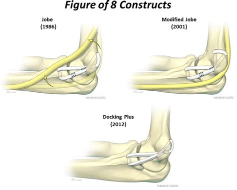 Figure of eight UCL reconstruction constructs | Download Scientific Diagram