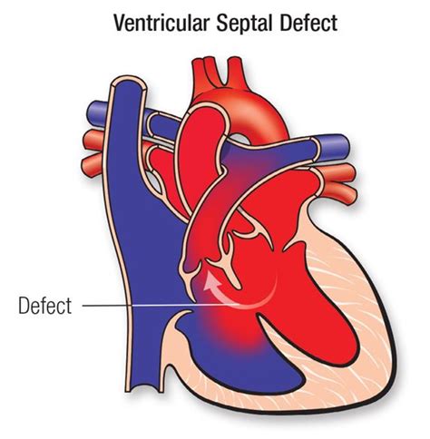 Ventricular Septal Defect Types