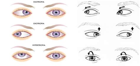 Types Of Nystagmus Ppt - Design Talk