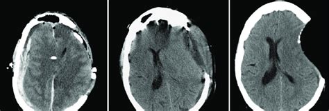 Post-operative complications after decompressive craniectomy. (a)... | Download Scientific Diagram