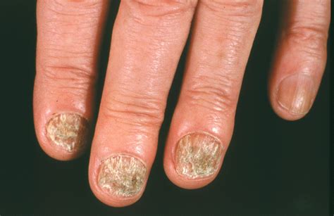 Nail fungus - symptoms, causes and risk factors - Home Remedy and Natural Cures