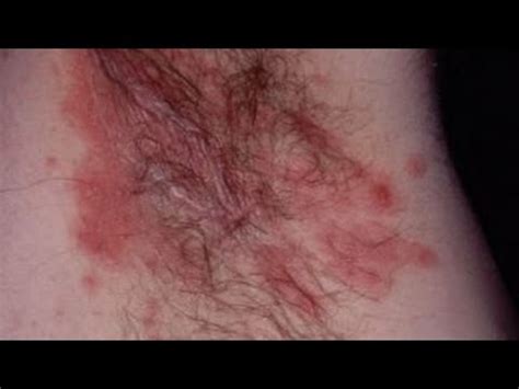 How to Get Rid of an Armpit Rash Fast | How to Cure Armpit Rash at Home ...