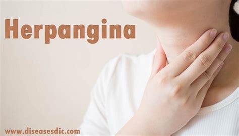 Herpangina – Symptoms, Complications and Treatment