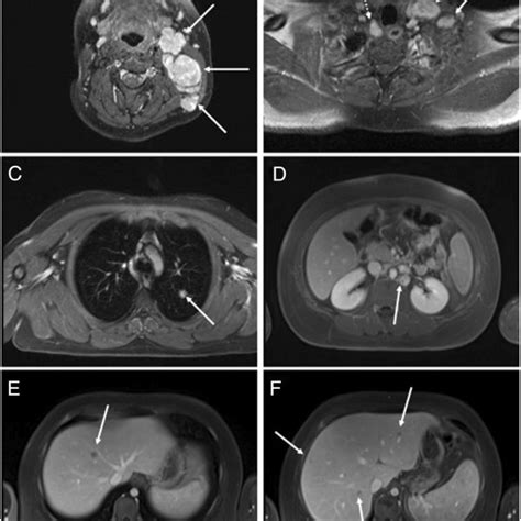 Initial radiologic staging confirming lymphoma Ann Arbor stage IV. (A)... | Download Scientific ...