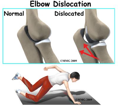 Elbow Dislocation | 👨‍⚕️Singapore Orthopaedic & Neurosurgery Clinic