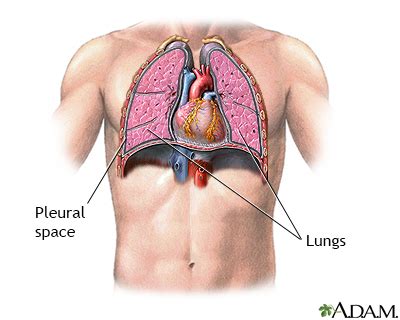 Broken Rib Punctured Lung