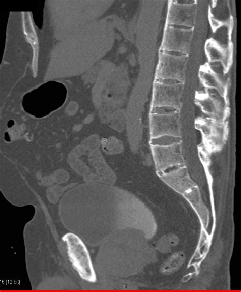 Ankylosing Spondylitis CT Scan