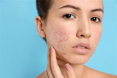 10 Facts You Should Know Before Using Accutane - U.S. Dermatology Partners