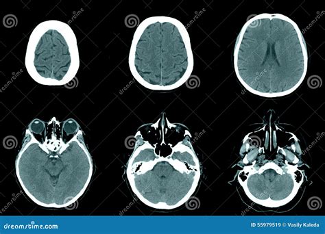 Normal head on CT scans stock image. Image of cranium - 55979519