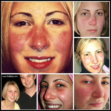 “Cover up with makeup in the mirror…” | Lupus butterfly rash, Makeup, Lupus rash