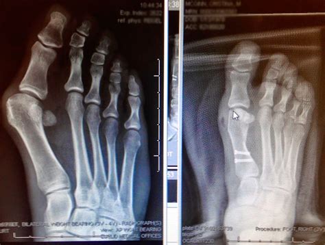 The Bloomin' Bunion: Bunion Surgery & Recovery Blog: Bunion Surgery Recovery Week 1