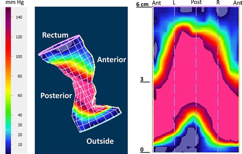 3D High‐definition anorectal manometry: Values obtained in asymptomatic volunteers, fecal ...