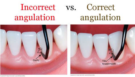 Periodontal Instruments: Concepts in periodontal scaling and how tos | Dental hygiene instrument ...