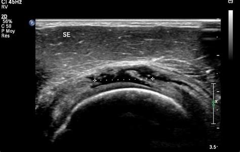 Supraspinatus Tendon Tear Ultrasound