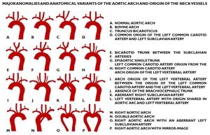 ECR 2019 / C-1656 / Anomalies and anatomical variants of the aortic arch and origin of the neck ...