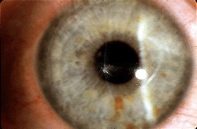 Corneal Abrasion Eye Vision Problem