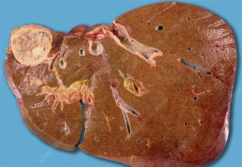 Hydatid cyst of liver - Stock Image M170/0410 - Science Photo Library