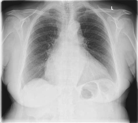 Cardiomegaly X Ray - tacitceiyrs